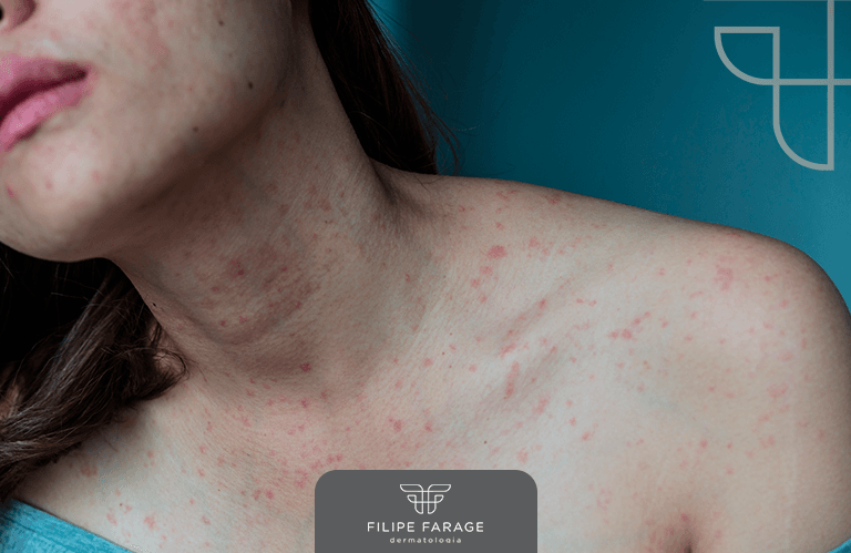 Alergias Cutâneas: Principais sintomas e como é feito o tratamento