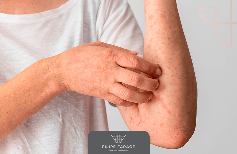 Doenças de Pele Autoimunes