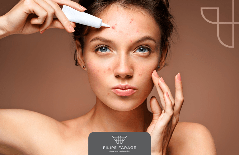 Perguntas Frequentes Sobre Acne