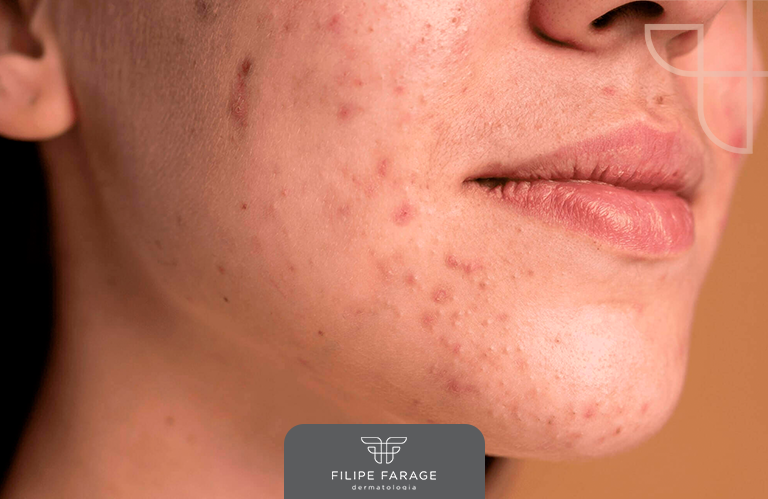 Acne: dicas para uma pele saudável