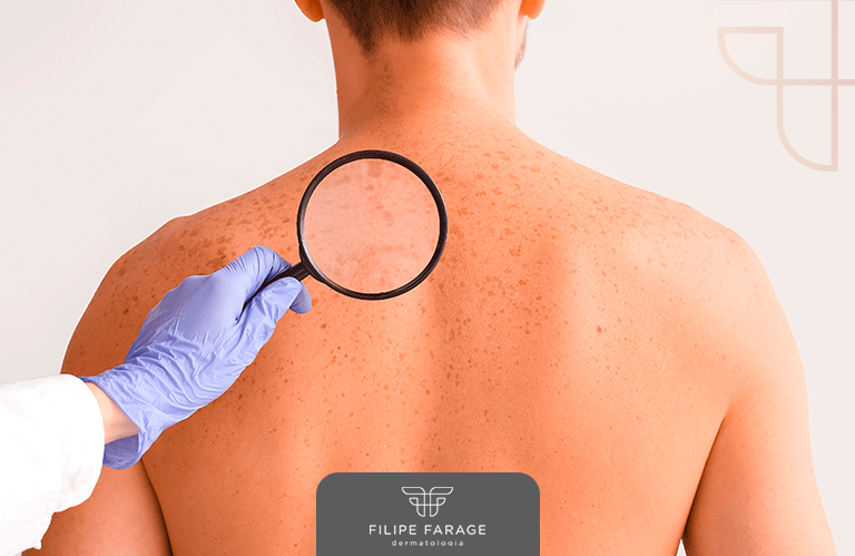 Entenda a relação entre Câncer de Pele e Exposição Solar