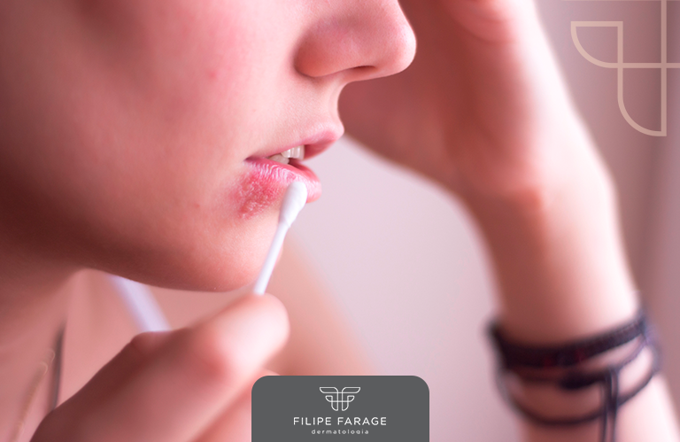Mitos e verdades sobre o Herpes Labial