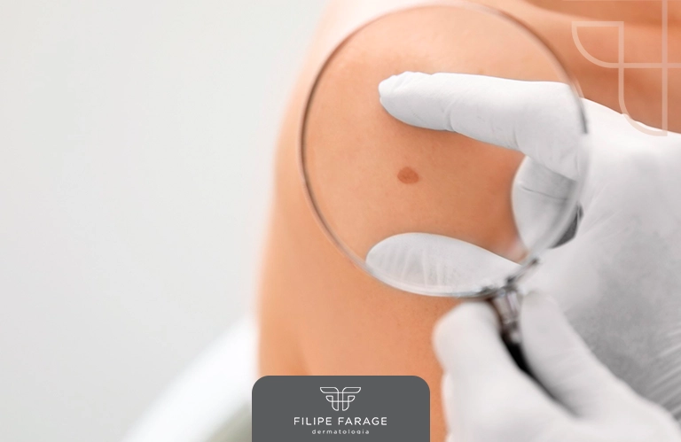 Descubra quando é necessário fazer a biópsia da pele