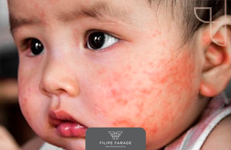 Dermatite atópica na infância: como os pais podem ajudar seus filhos?