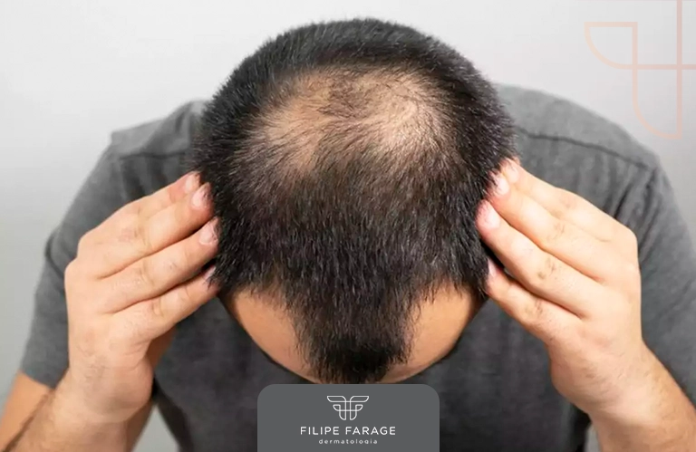 Fato ou fake? Desvende alguns mitos sobre a calvície