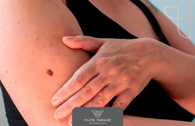 Câncer de Pele: Sintomas, Sinais de Alerta e Prevenção