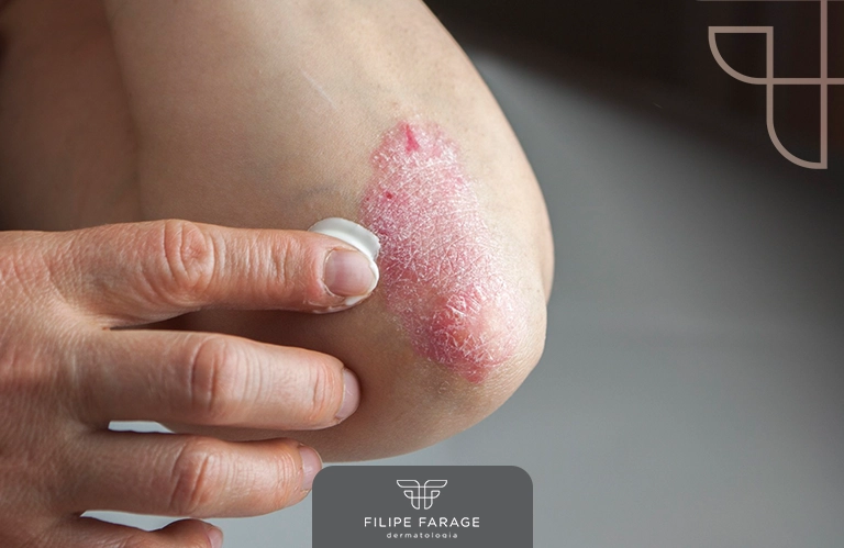 É possível tratar a psoríase na gravidez? Entenda o protocolo de controle