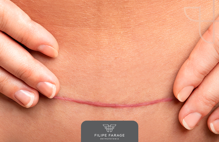 Entenda a diferença entre queloide e cicatriz hipertrófica