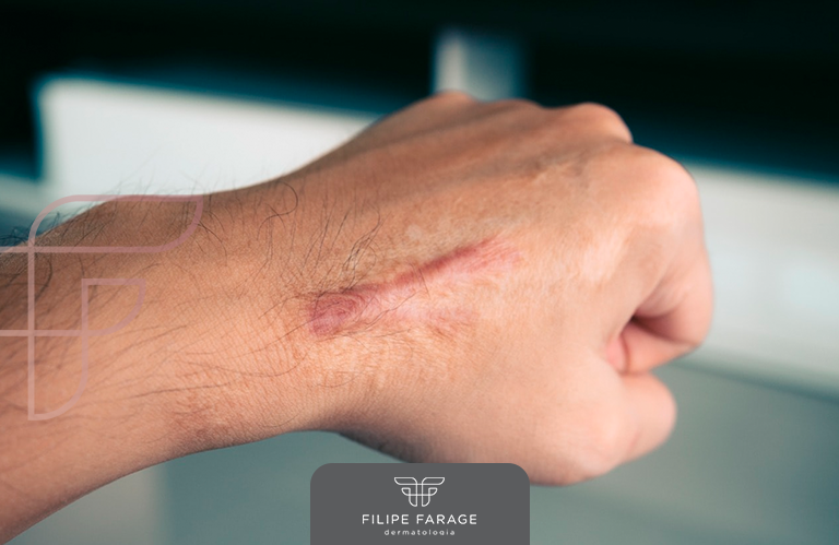 Entenda como surgem os queloides e como evitá-los