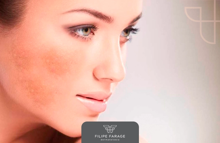 Mitos e verdades sobre o Melasma