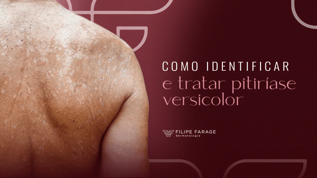 Como identificar e tratar pitiríase versicolor