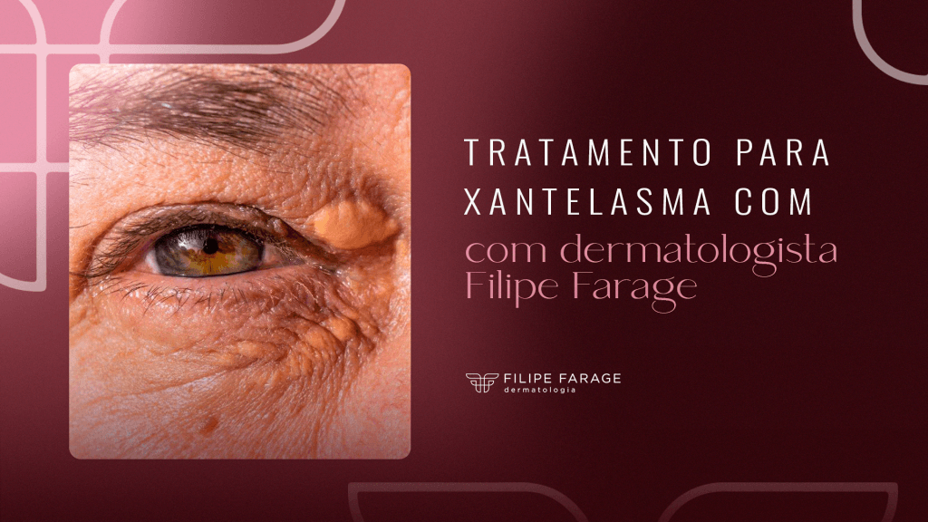 Tratamento para xantelasma com dermatologista Filipe Farage