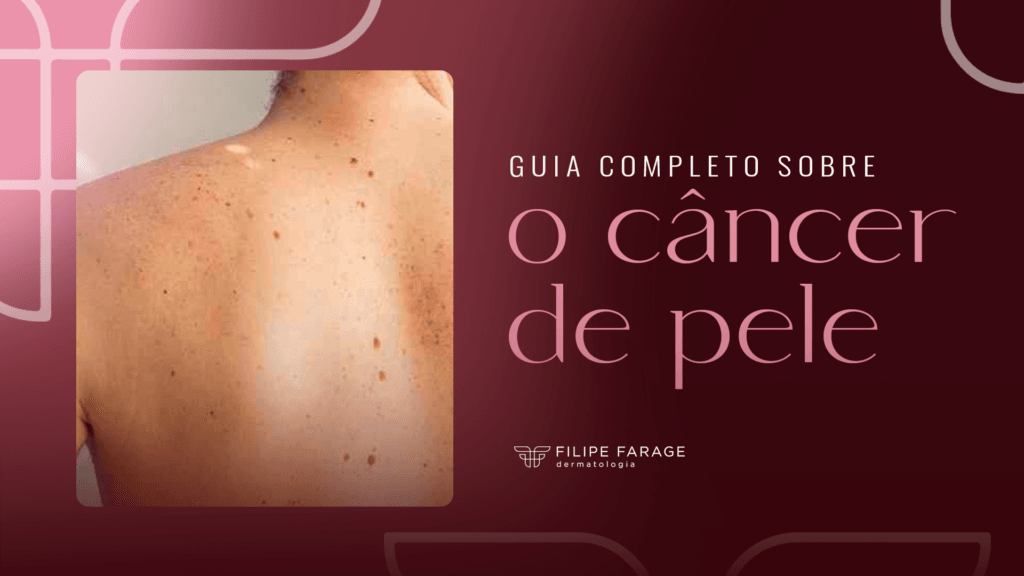 Guia completo sobre o câncer de pele