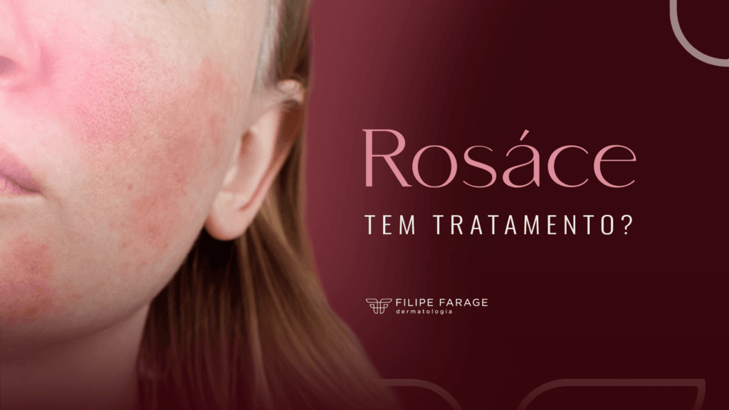 Rosácea tem tratamento?