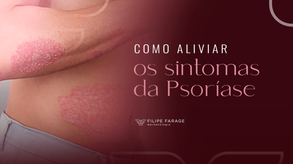 Como aliviar os sintomas da Psoríase