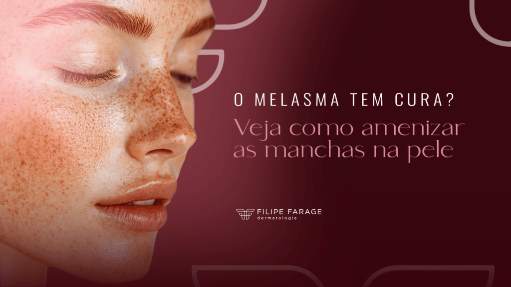 O Melasma tem cura? Veja como amenizar as manchas na pele