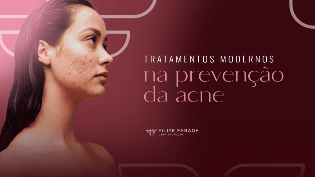 Tratamentos modernos na prevenção da acne